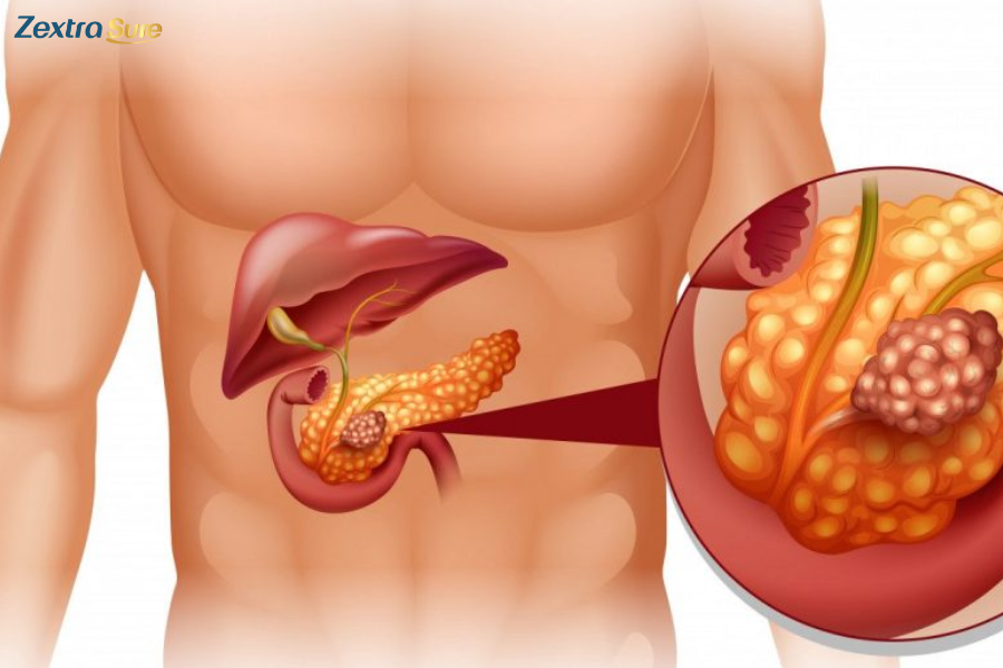 Liver cancer can lead to varicose veins